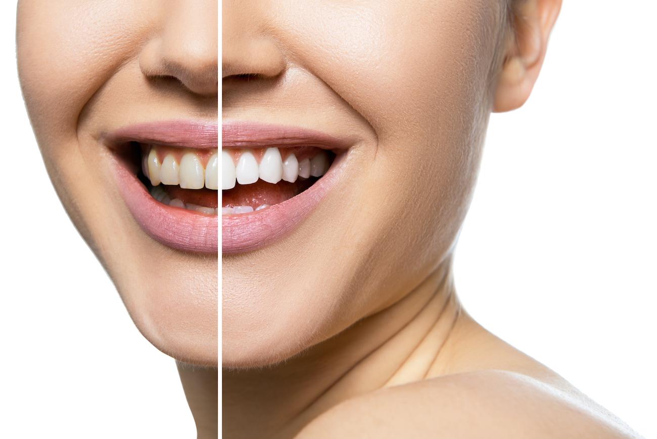 Boost Versus Zoom Teeth Whitening at Alegria Dental Care in Southwest Houston