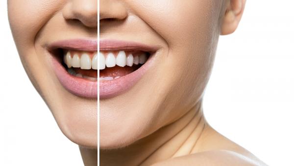 Boost Versus Zoom Teeth Whitening at Alegria Dental Care in Southwest Houston