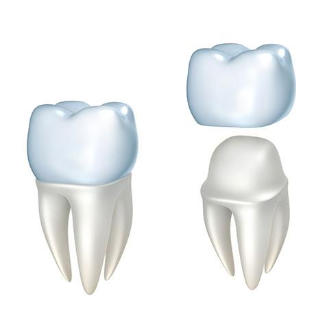 Dental Crown at Alegria Dental Care