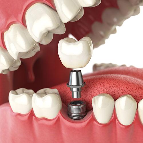Dental Implants Alegria Dental Care