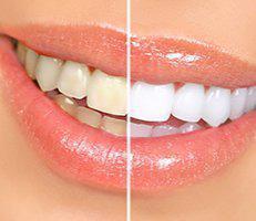 Teeth Whitening Alegria Dental Care